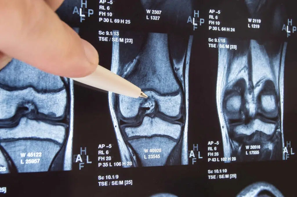 Anatomía básica de la rodilla