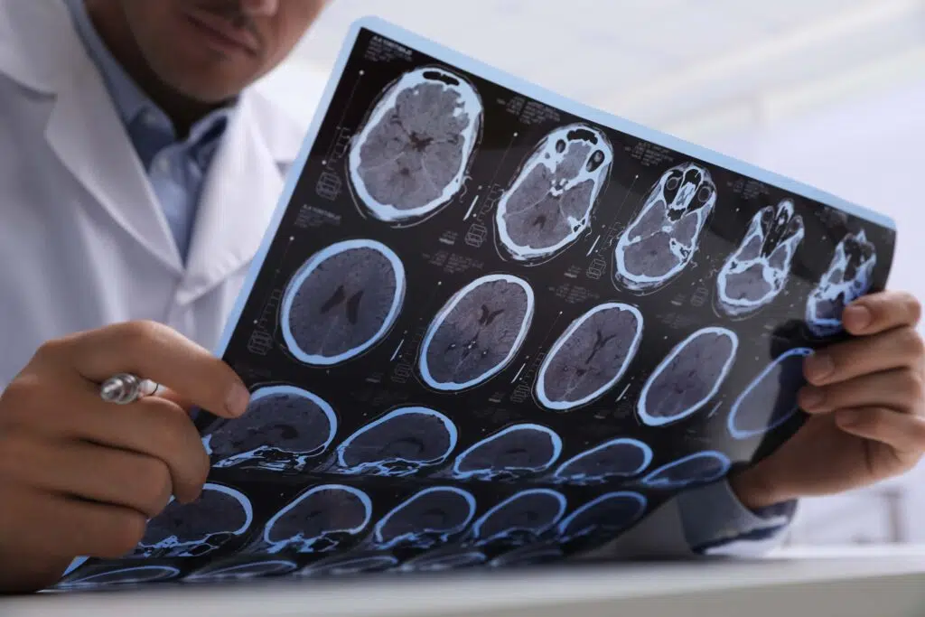 Cuando ocurre un accidente y se produce daño cerebral, ¿qué se debe hacer?