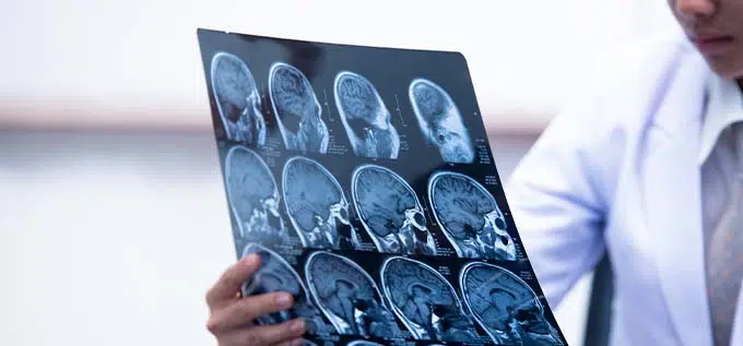 lesión cerebral en un accidente