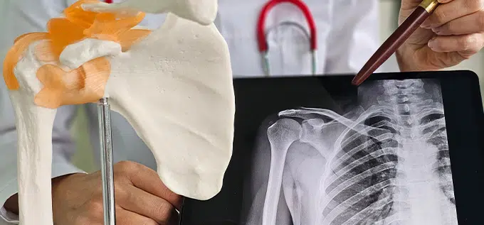 indemnización por operación de hombro